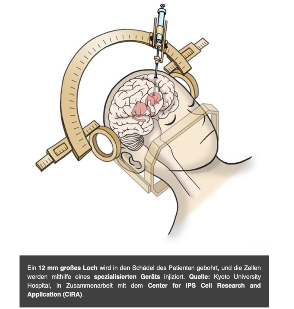 Screenshot 2025 01 31 at 8.56.48 PM - Parkinson: Das Geheimnis der ruhenden Stammzellen!